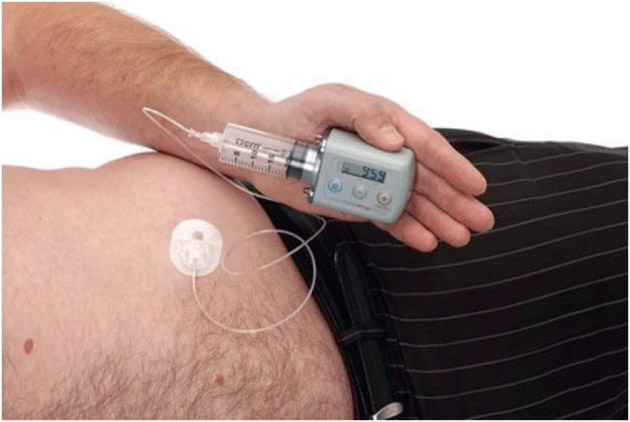Other device-assisted treatments for Parkinson's disease